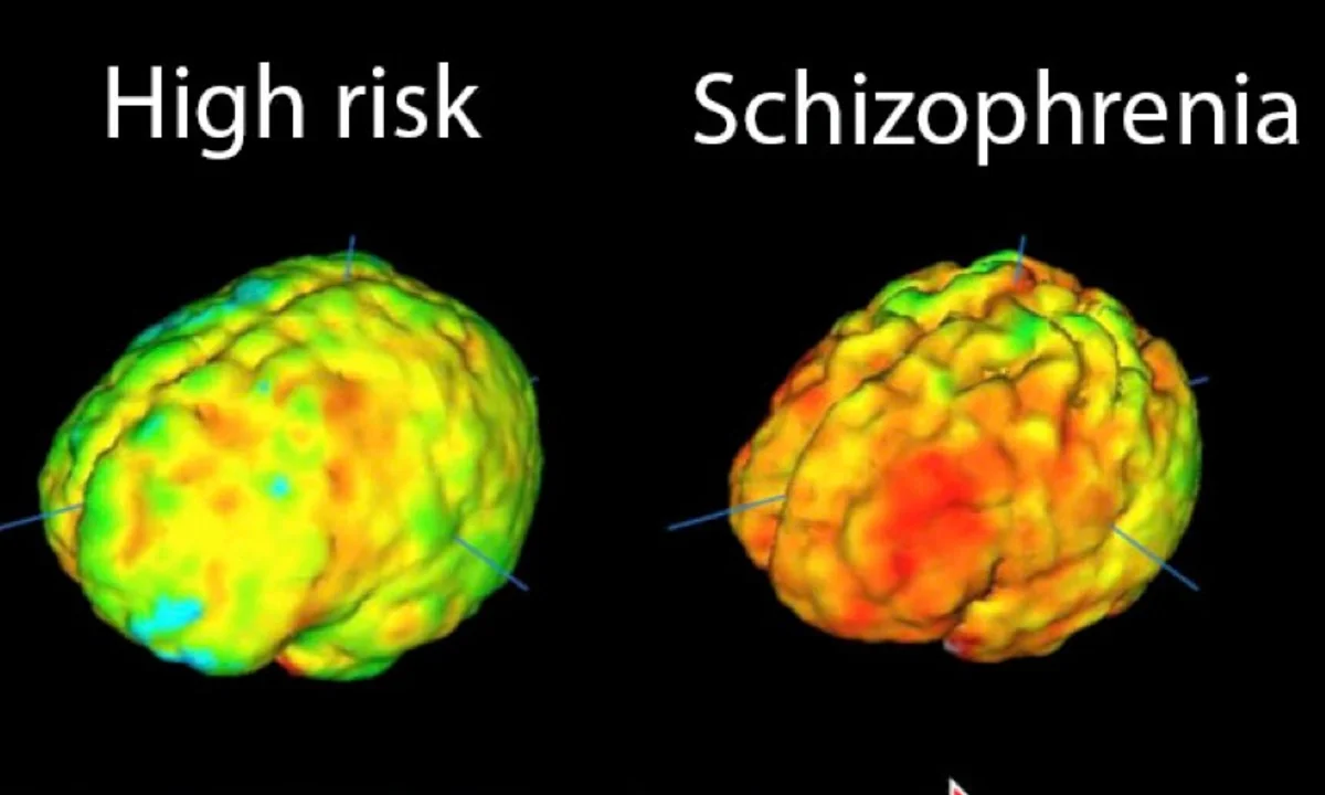 One Rare Condition Seems to Protect The Brain From Schizophrenia
