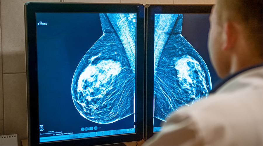 New treatment with fewer side effects reduces breast density | Karolinska Institutet