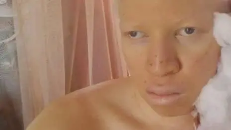 Albinism: Nigeria’s Invisible Millions