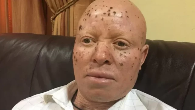 Albinism: Nigeria’s Invisible Millions