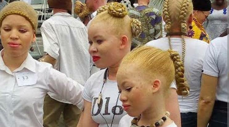 Nigeria albinism awareness challenges for equal rights and healthcare access
