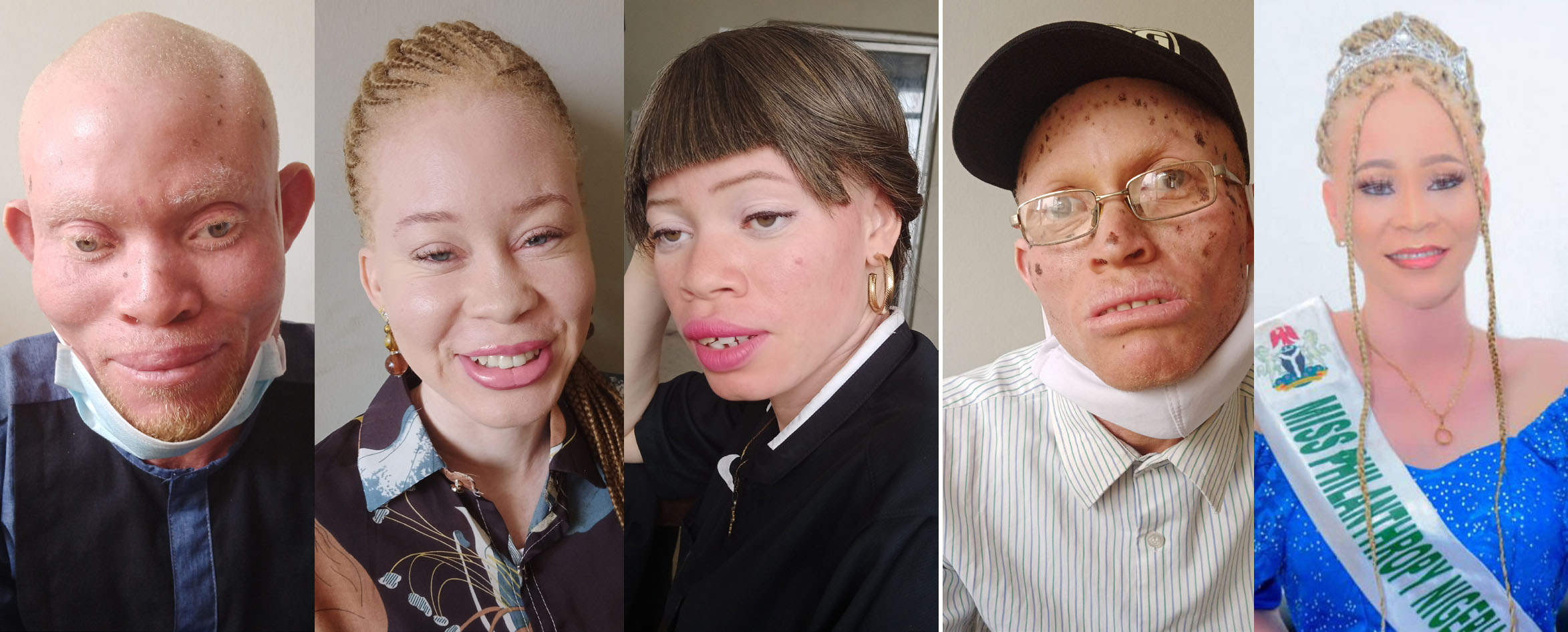 Albinism: Nigeria’s Invisible Millions