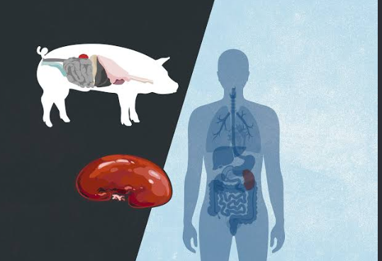 Tim Andrews with doctors after pig kidney transplant